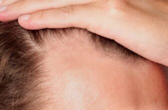 New Baldness Drug Boosted Hair Progress by 539% in Trials